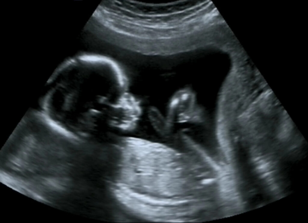 Tryghedsscanning i den tidlige graviditet